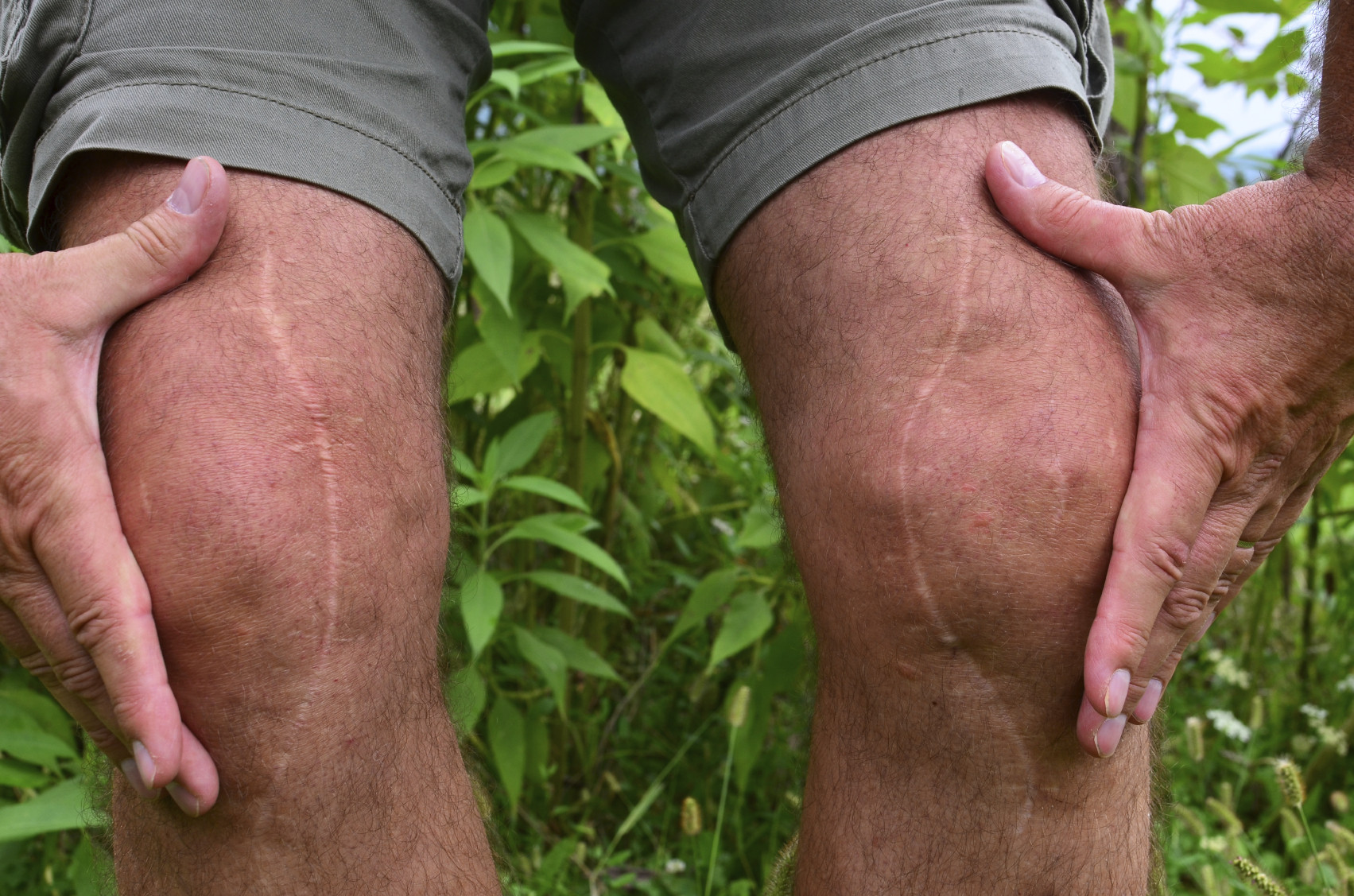 Total Knee Replacement Rehabilitation: Complete Guide to Faster, Safer Recovery